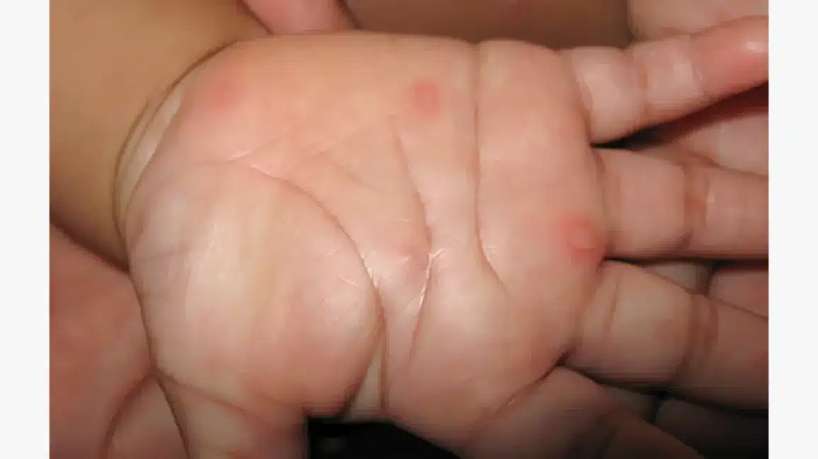 Hand-foot-and-mouth-disease-body1-1.webp